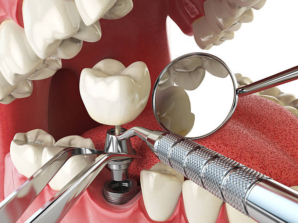 Best Urgent Care for Lost Fillings or Crowns in Tuscoosa, AL